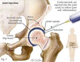 Epidural steroid injections cervical spine