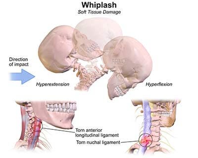 whiplash treatment specialists doctors brooklyn nyc