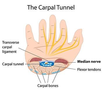 Carpal Tunnel Syndrome Specialists Doctors | Brooklyn NYC