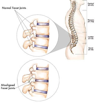 Lumbar Facet Joint Pain - Treatment & Exercises At Home