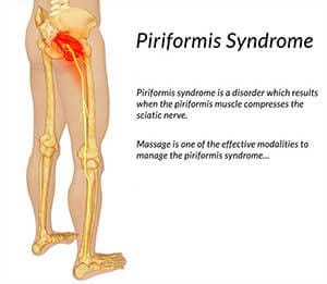 Piriformis Syndrome, Symptoms, Causes & Relief