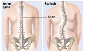 scoliosis diagnosis treatment back pain doctors brooklyn nyc