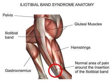 ILIOTIBIAL BAND SYNDROME