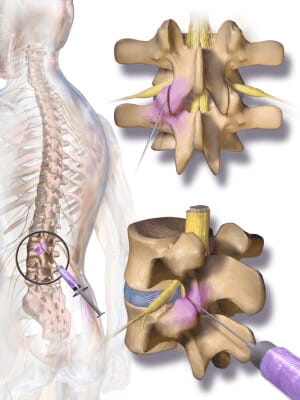 Spinal Cord Stimulation in NYC  Sports Injury & Pain Management