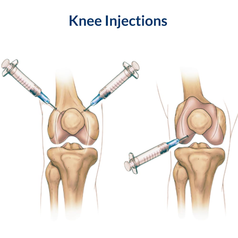 Knee Injections Specialists in NYC