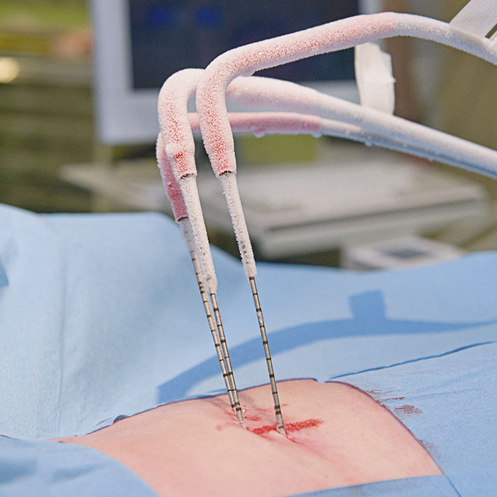 Cryoablation Treatment - Specialists Doctors | Brooklyn NYC