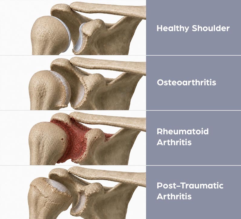 Types of shoulder arthritis including osteoarthritis, rheumatoid arthritis, and post-traumatic arthritis